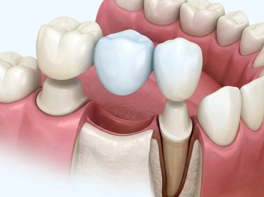 Medical illustration of a dental bridge being placed over prepared abutment teeth filling a gap.