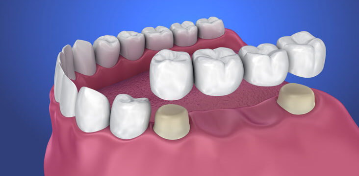 Get Dental Crowns and Bridges in Tysons Corner, Today!