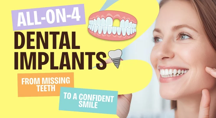 All-On-4 Dental Implants