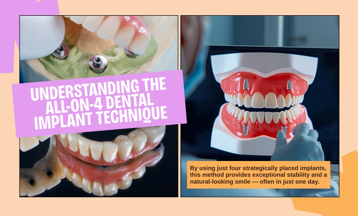 All-On-4 Dental Implant Model on Screen