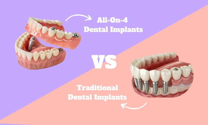 All-On-4 vs. Traditional Dental Implants