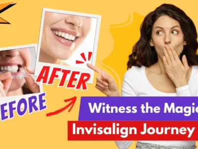 Witness the Magic: Invisalign Before and After Journeys Revealed!