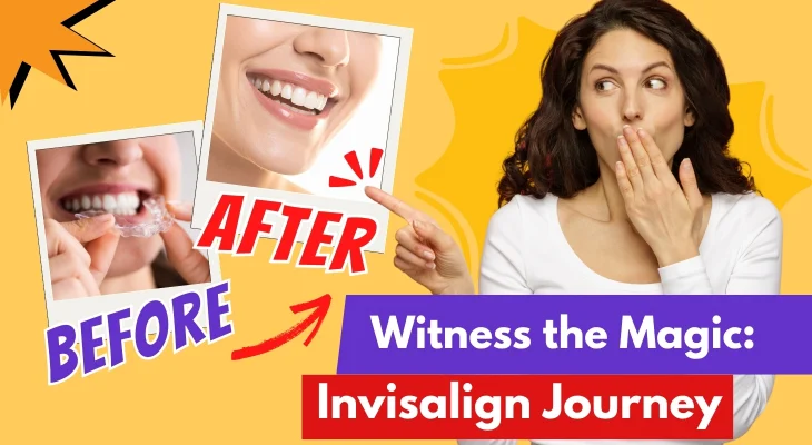 Invisalign Before and After