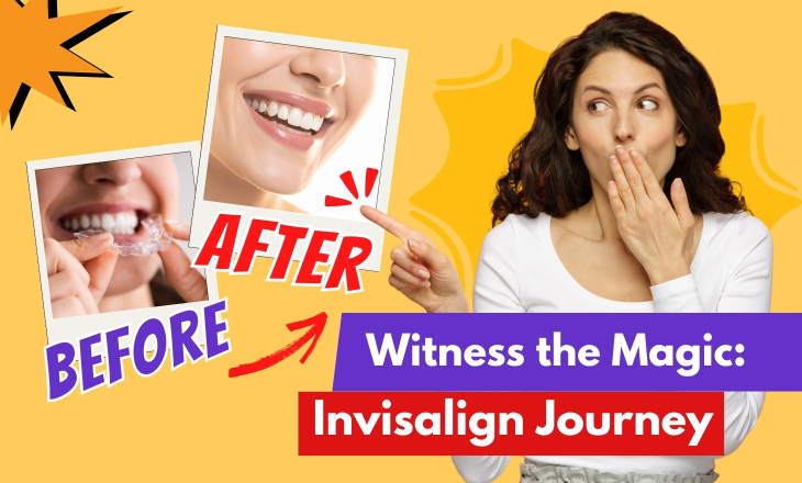 Invisalign Before and After