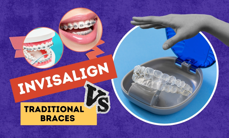 Invisalign Aligner with Traditional Braces Beside