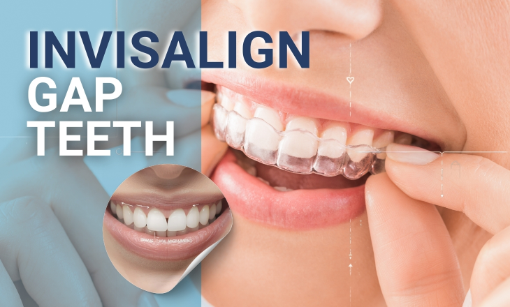 Invisalign Gap Teeth