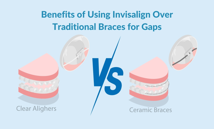 Invisalign vs Traditional Braces