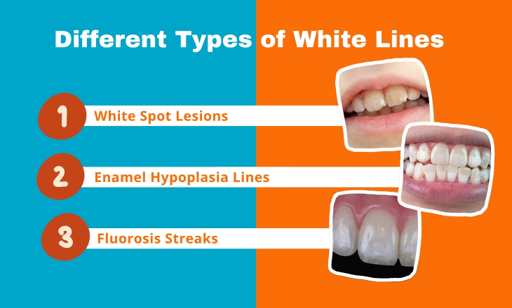 Types of White Lines on Teeth over Orange Background