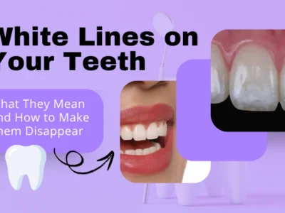 White Lines on Your Teeth: What They Mean and How to Make Them Disappear