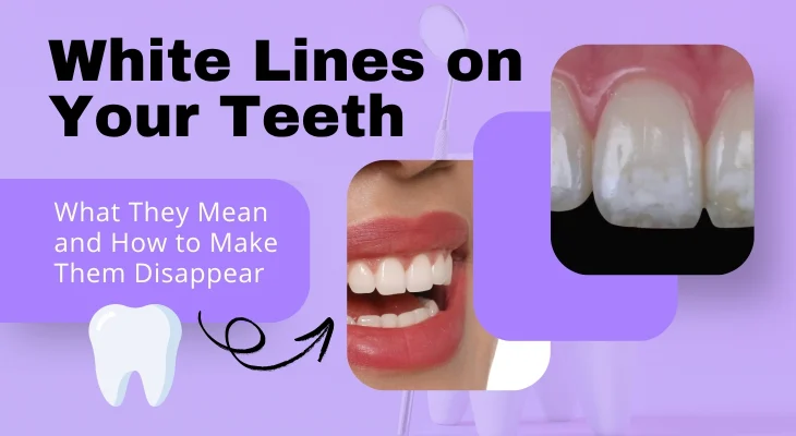 White Lines on Your Teeth