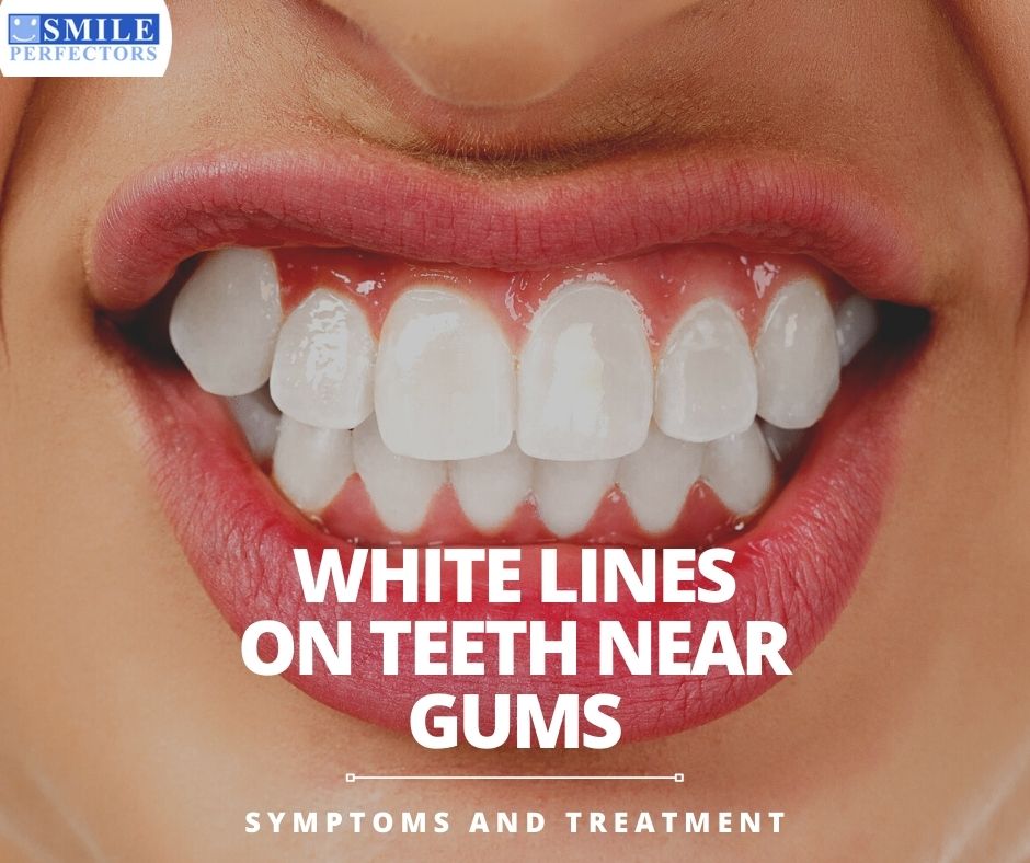 bladeren vers rekenmachine White Lines On Teeth Near Gums – Symptoms and Treatment
