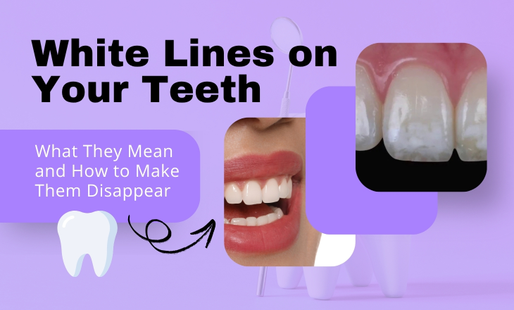 White Lines on Your Teeth