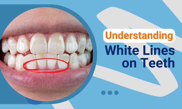White Lines on Teeth Close up and Red Circle Over