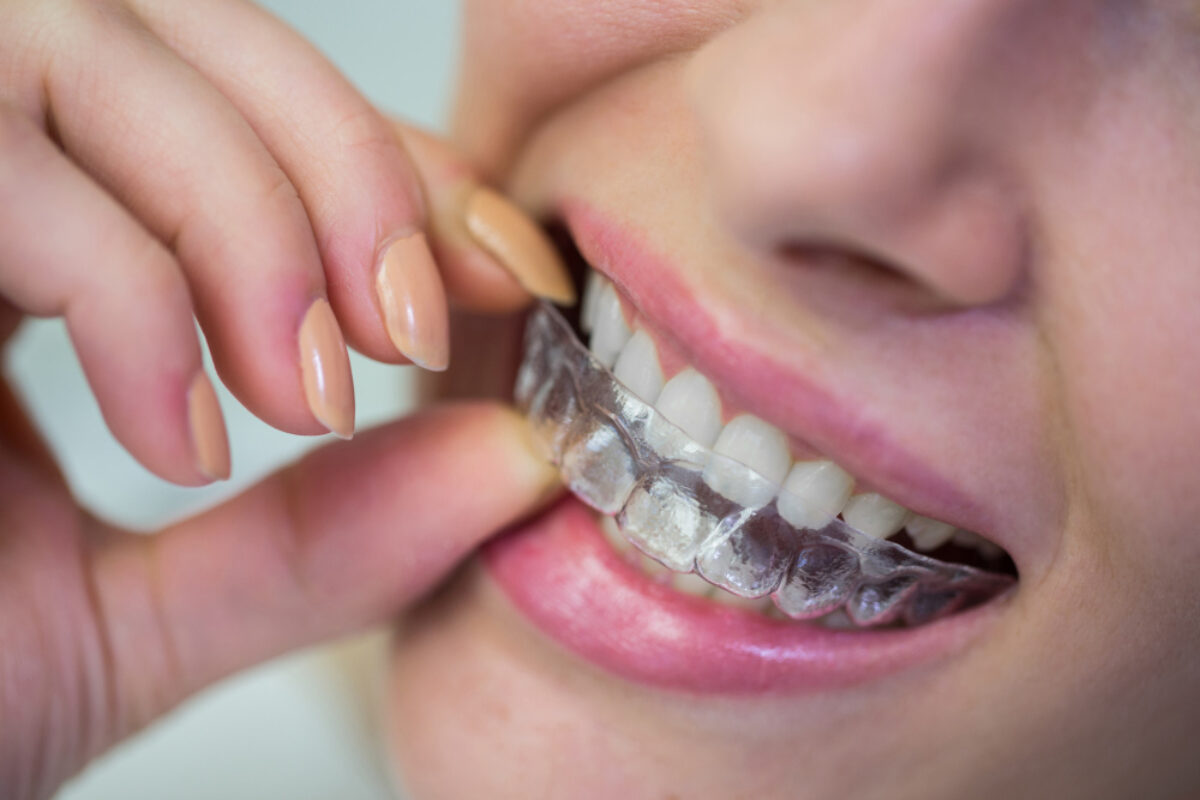 Discover How Braces Effectively Correct Overbites