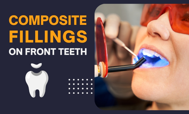 Composite Fillings on Front Teeth