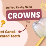 Dental Crowns for Root Canal-Treated Teeth
