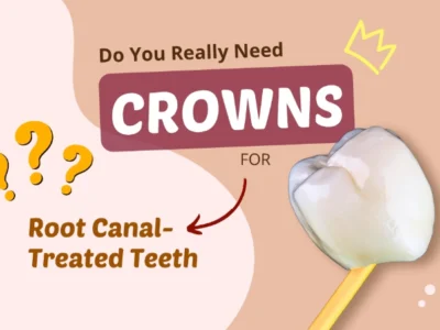Do You Really Need Crowns for Root Canal-Treated Teeth? What You Need to Know