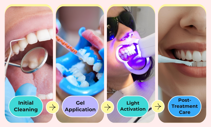 Zoom Teeth Whitening Zoom Teeth Whitening Process Showing by Four Images