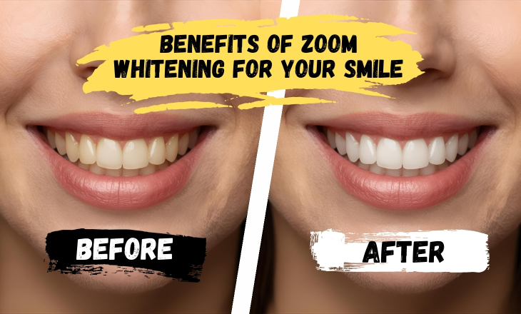 Zoom Whitening Benefits Before and After Woman's Teeth Whitening Close up